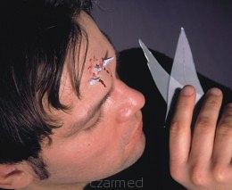 Rana Latexowa -kawałki szkła wbite w ciało